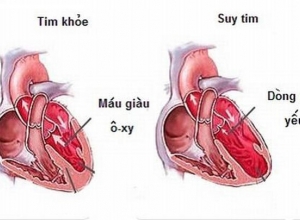 Bệnh Suy Tim Là Gì? Nguyên Nhân, Triệu Chứng Của Bệnh
